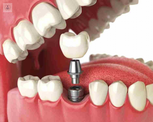 Implantes Dentales: Un procedimiento actualmente sencillo y con grandes beneficios