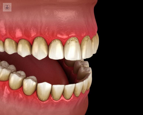 La periodoncia y su importancia para evitar la pérdida de los dientes
