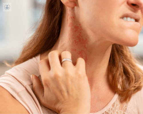 9-de-cada-10-personas-con-lupus-son-mujeres-en-edad-reproductiva imagen de artículo