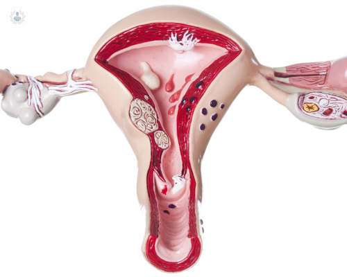 hablemos-de-miomas-es-cancer imagen de artículo