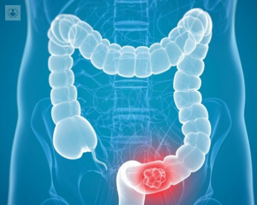 endoscopia-colonoscopia-que-son-y-para-que-sirven imagen de artículo