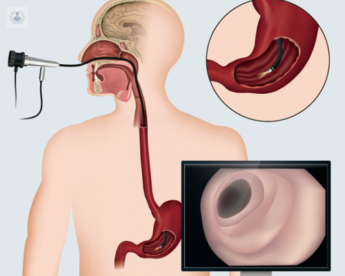 Endoscopía Digestiva Alta: qué es y cómo se realiza