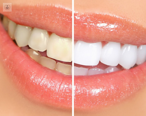 Blanqueamiento Dental: ¿Cuáles son sus beneficios?
