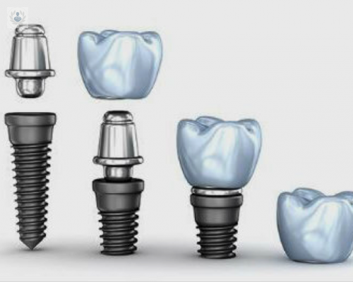 Implantes Dentales: una especie de tuerca para atornillar después un diente