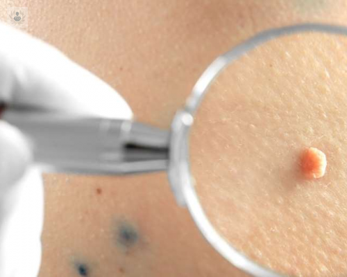 se-puede-detectar-el-virus-del-papiloma-humano-vph-mediante-sintomas imagen de artículo