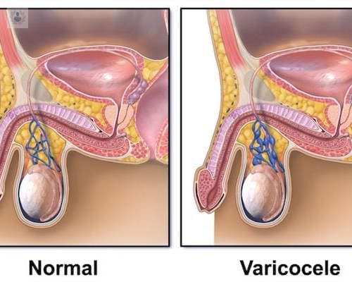 que-relacion-tiene-el-varicocele-con-la-infertilidad-masculina imagen de artículo