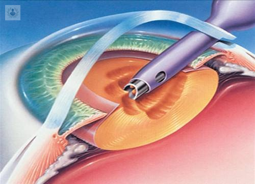 cirugia-de-cataratas-con-ultrasonido-un-procedimiento-rapido-y-seguro imagen de artículo