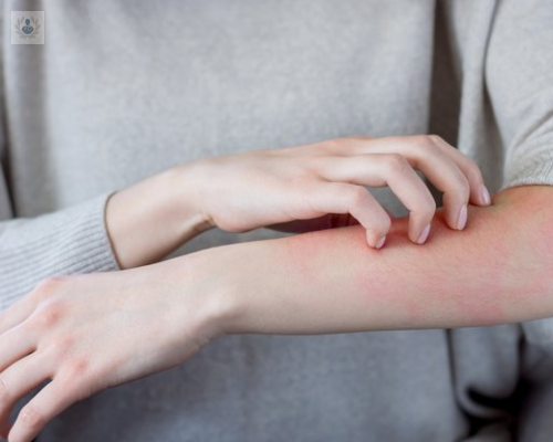 Dermatitis Atópica ¿cómo afecta la vida diaria en las personas que sufren esta enfermedad?