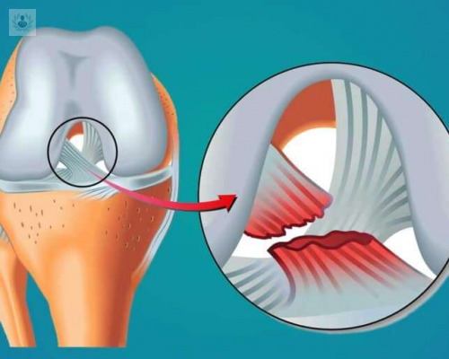 ruptura-del-ligamento-cruzado-anterior-cual-es-el-tratamiento imagen de artículo
