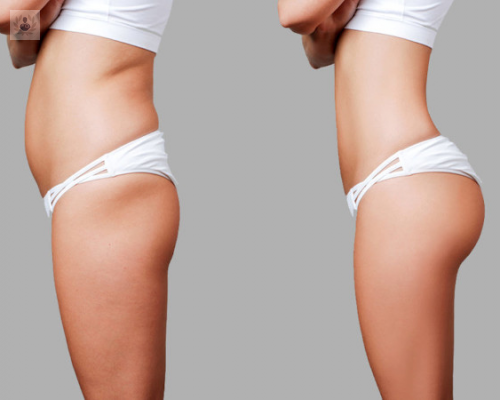 que-es-el-mommy-makeover-y-cuales-son-sus-beneficios imagen de artículo