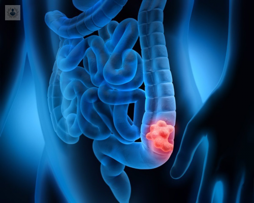 tratamiento-de-cancer-de-colon-por-colonoscopia imagen de artículo