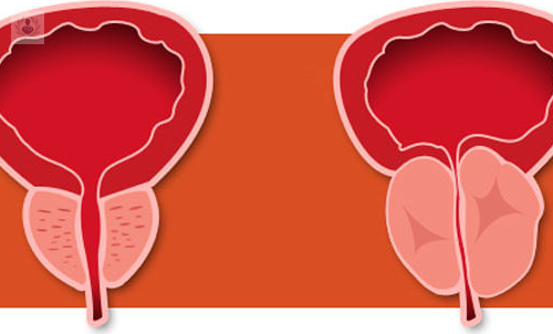 hiperplasia-prostatica-que-es-y-como-debe-tratarse imagen de artículo