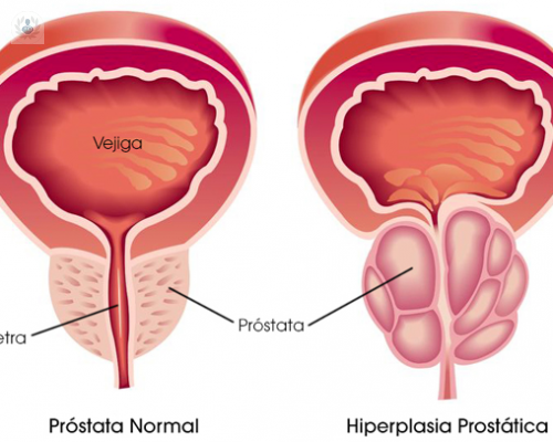 Enfermedades de la próstata: Hiperplasia Prostática Benigna