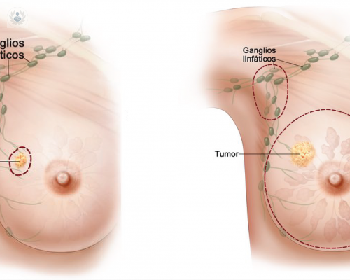 las-enfermedades-mas-comunes-del-seno-nodulos-mamarios-parte-ii imagen de artículo