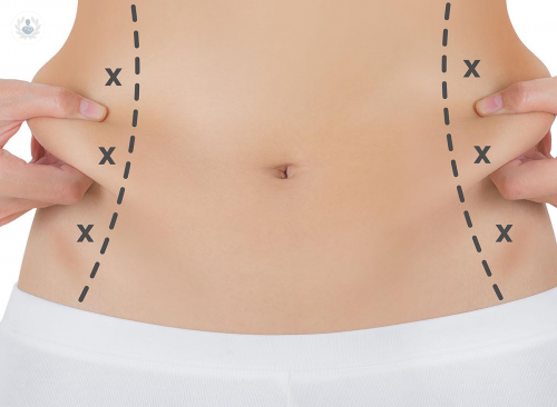 liposuccion-ultrasonica-vaser-hd-vs-liposuccion-clasica-tumescente imagen de artículo