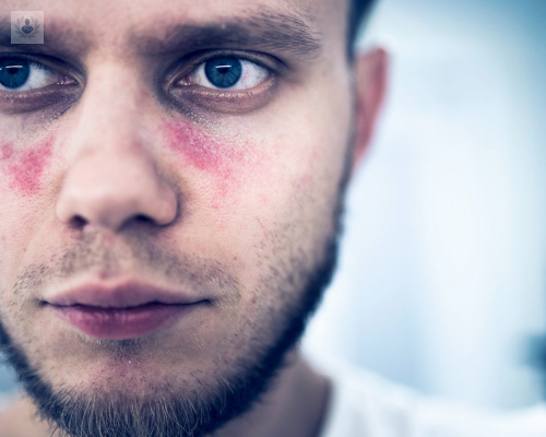 lupus-una-enfermedad-que-usted-debe-conocer-para-detectarla-oportunamente imagen de artículo