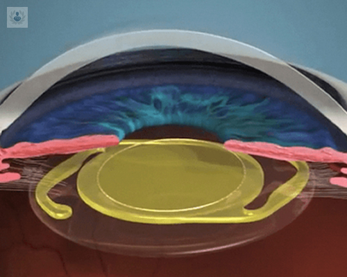 lentes-intraoculares-solucion-correctiva-para-una-vision-optima-libre-de-gafas imagen de artículo