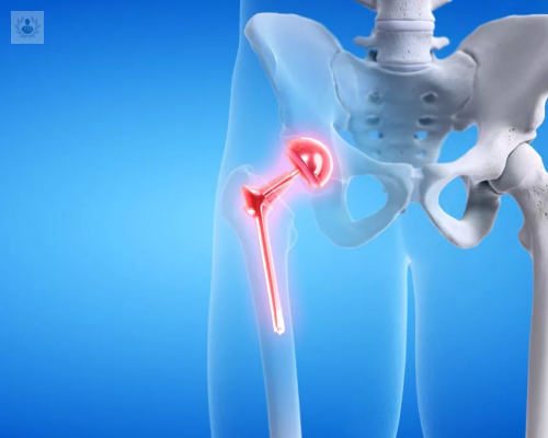 protesis-de-cadera-que-es-y-que-cuidados-necesita imagen de artículo