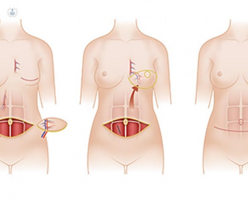 reconstruccion-mamaria-sin-implantes-una-alternativa-con-una-sensacion-mas-natural imagen de artículo