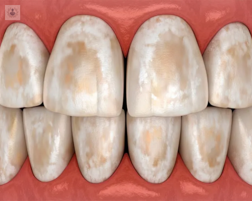 que-es-la-hipomineralizacion-de-incisivos-y-molares-him-y-como-se-trata imagen de artículo