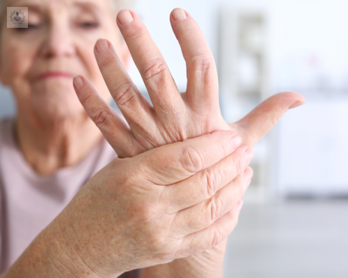 Artritis Reumatoide: qué es y cuál es su tratamiento