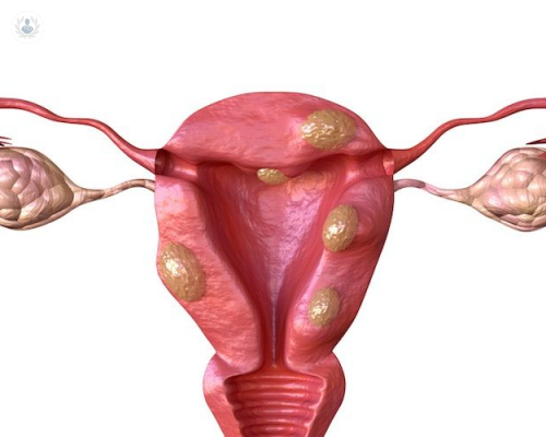 miomas-uterinos-fibromas imagen de artículo