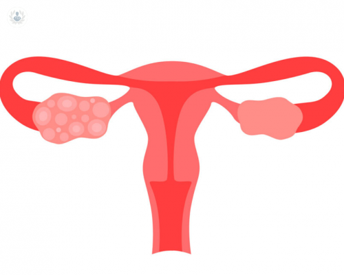 Quistes de ovario: síntomas, tipos y tratamiento
