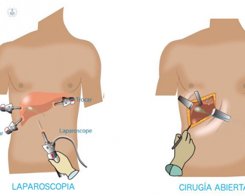 extirpacion-de-la-vesicula-biliar-cuales-son-los-procedimientos-disponibles imagen de artículo