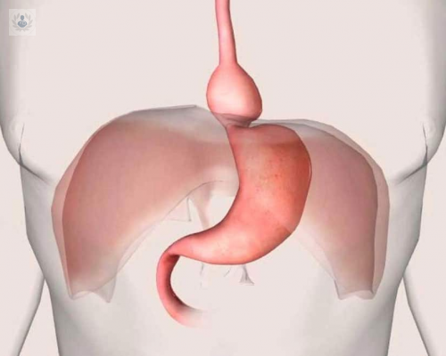 hernia-hiatal-que-es-sintomatologia-y-tratamiento imagen de artículo