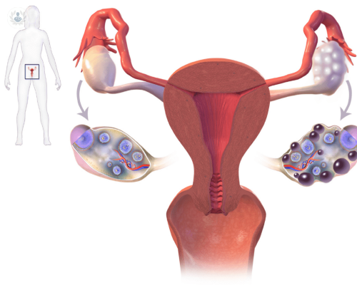 ¿Qué es el Síndrome de Ovario Poliquístico (SOP)? 