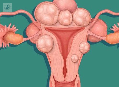 Miomas Uterinos: ¿Qué Son y Cómo Afectan la Salud Reproductiva?