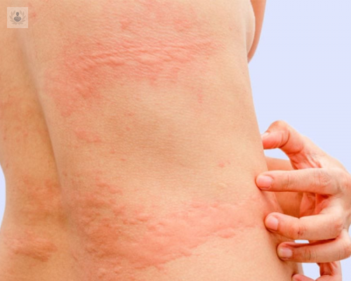 urticaria-que-es-cuales-son-los-sintomas-y-como-se-trata imagen de artículo