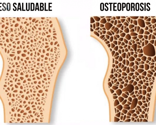 Osteoporosis: qué es, cómo prevenirla y tratarla