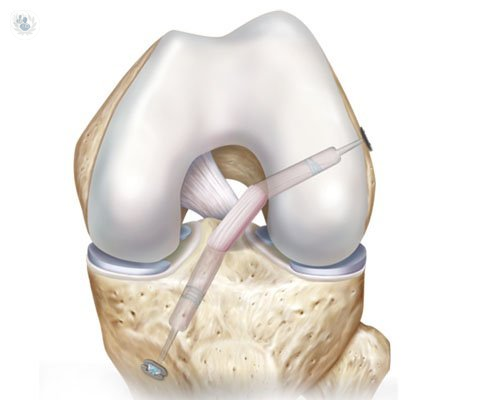 rotura-del-ligamento-cruzado-anterior-como-tratarla imagen de artículo