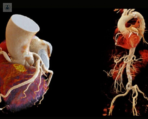 Angiotomografía de Arterias Coronarias: diagnóstico oportuno