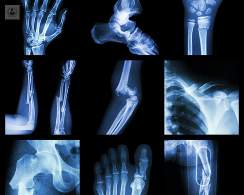 fracturas-origen-y-diagnostico imagen de artículo