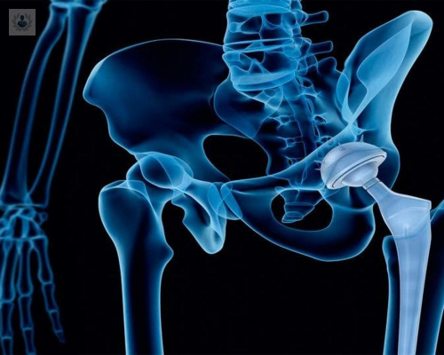protesis-de-cadera-cuales-son-los-cuidados-postoperatorios imagen de artículo