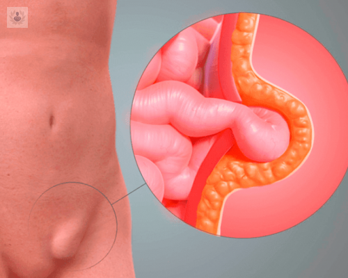 hernia-inguinal-sintomas-causas-y-tratamiento imagen de artículo