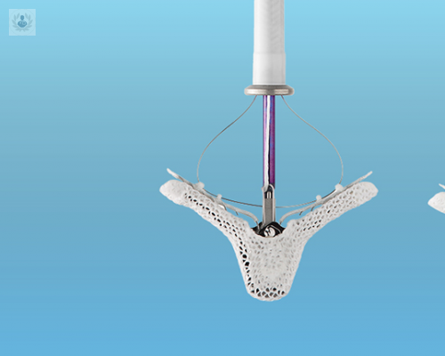 mitraclip-conoce-mas-sobre-este-dispositivo imagen de artículo