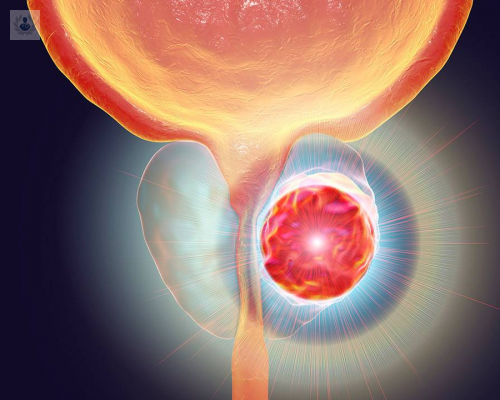 hiperplasia-prostatica-como-tratarla-con-laser-de-holmio imagen de artículo