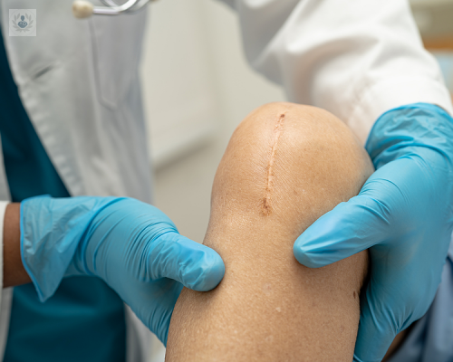 artroplastia-de-rodilla-causas-y-cirugia imagen de artículo