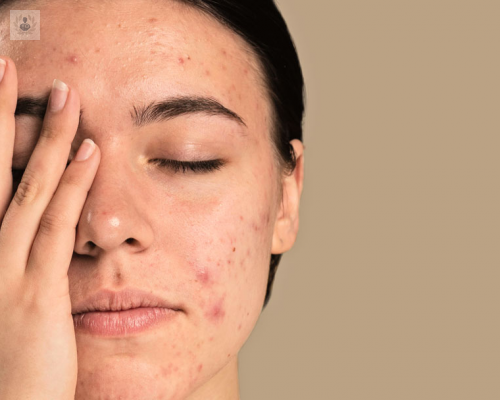 factores-que-no-sabias-que-ocasionaban-acne imagen de artículo