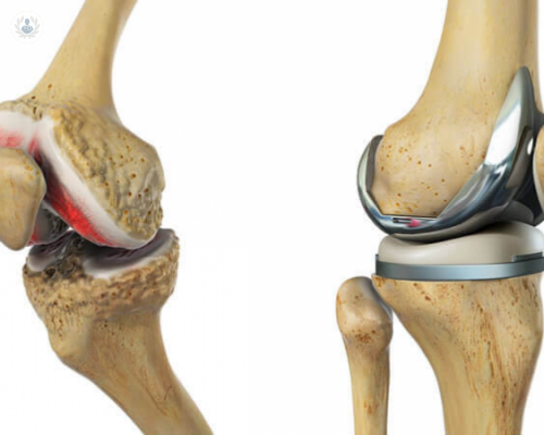Prótesis de Rodilla para el dolor y desgaste articular