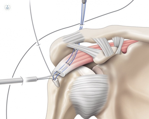 artroscopia-de-hombro-metodo-quirurgico-diagnostico imagen de artículo