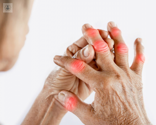 artritis-un-padecimiento-no-exclusivo-de-la-manos imagen de artículo