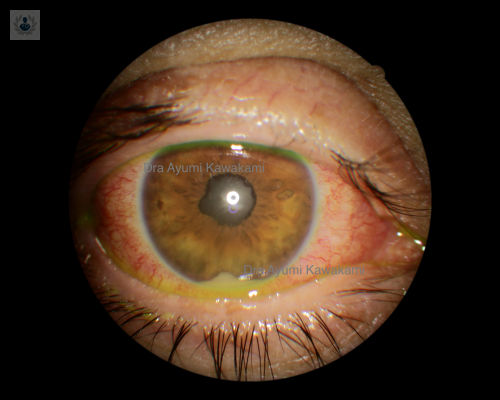 sifilis-ocular-cual-es-el-tratamiento imagen de artículo