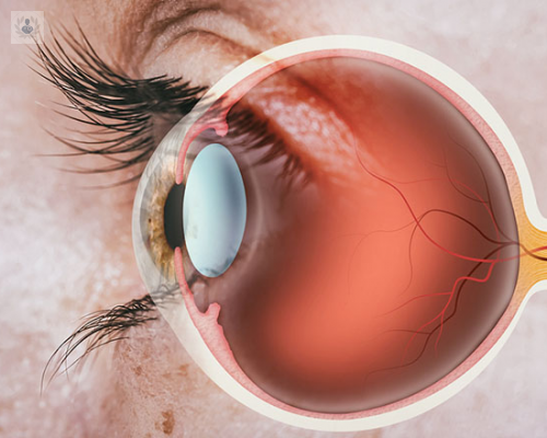 Retinopatía Diabética: la importancia de revisar tus ojos si padeces Diabetes