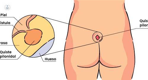 quiste-sacro-que-es-como-y-quien-lo-trata imagen de artículo