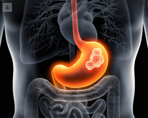 Cáncer de Estómago: signos de alerta para evitar llegar al quirófano