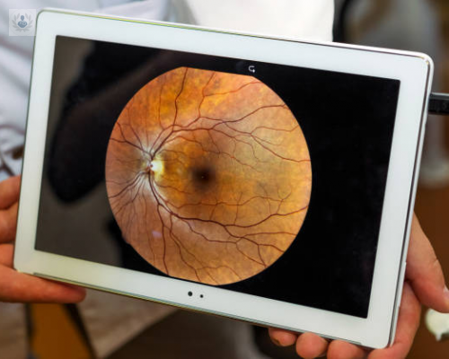 panfotocoagulacion-retiniana-que-es-y-como-se-realiza imagen de artículo